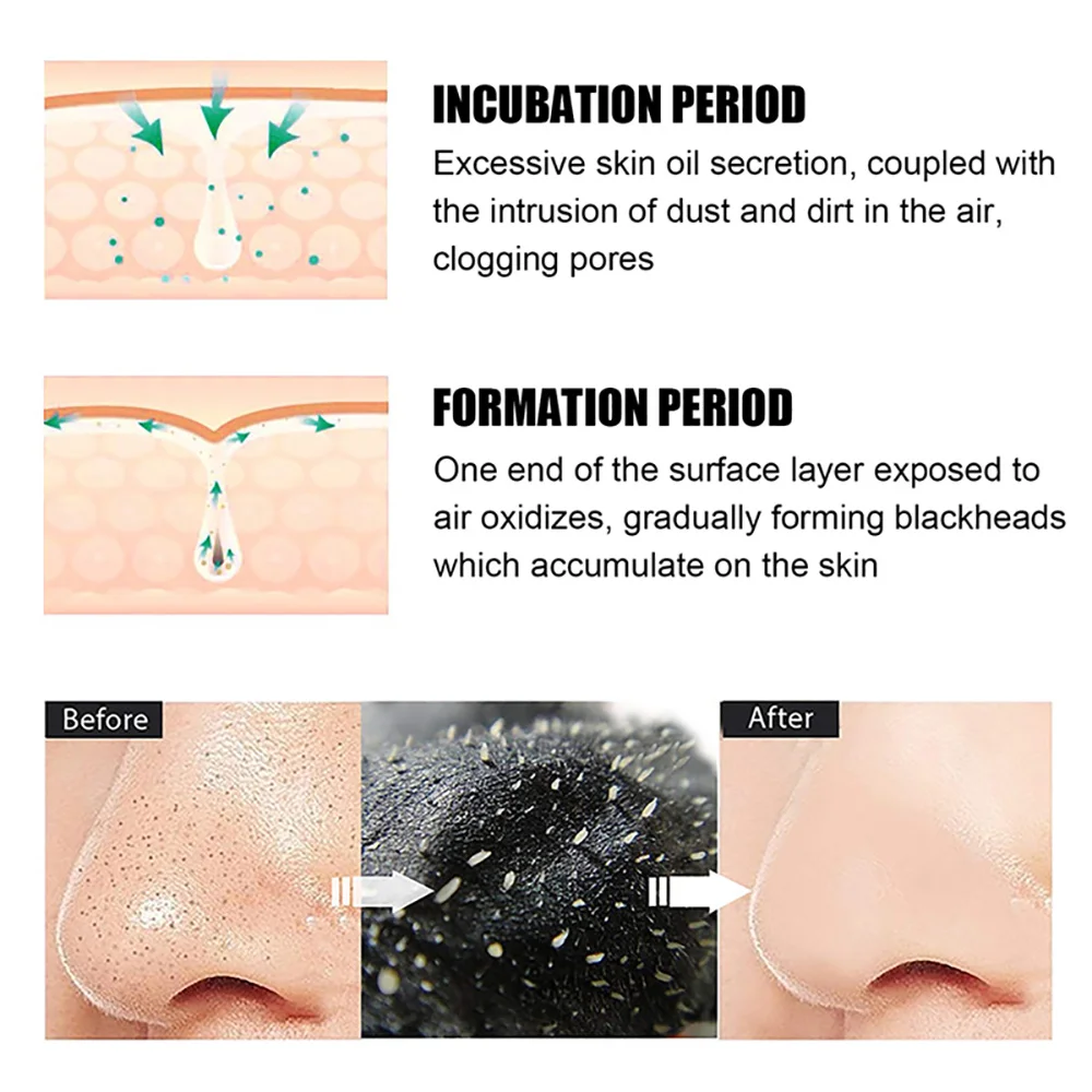 10/20/50/100PCS Blackhead Remo - Charcoal Pore Strip review and price