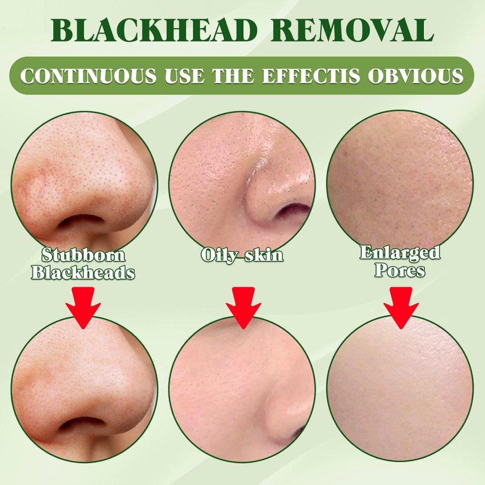15 Pack Blackhead Remover Nose - Charcoal Pore Strip review and price